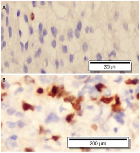 Figure 1. Survivin-stained, low-grade (A) and high-grade (B) glial tumour (x400).