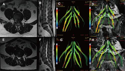 Figure 2 A 28-year-old woman had been suffering from radiating pain in the left leg for seven months. Preoperative sagittal (A) and axial (B) MRI showing huge disc herniation with complete dural sac stenosis at the L4/5 level. Diffusion tensor tractography (C and D), with colored FA scale fiber tracking, distinctly showed abnormalities located at the left L5 and S1 nerve root. Postoperative sagittal (E) and axial (F) MRI shows a large annular defect and partial removal of the nucleus pulposus and the close contact between the annulus fibrosus and the nerve root. Diffusion tensor tractography (G and H) with colored FA scale fiber tracking showed no obvious compression of the left 5 and S1 nerve root. Preoperation vs postoperative 3 months, ODI: 57.78 vs 20; NRS: 7 vs 2; mJOA: 8 vs 16.