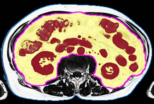 Figure 2 Segmentation of VAT in Dixon MRI fat image. Total abdominal volume is shown by the blue contour; visceral volume of interest is shown by the magenta contour; the Otsu threshold separates visceral adipose tissue VAT (yellow overlay) from inner organs (dark red overlay).