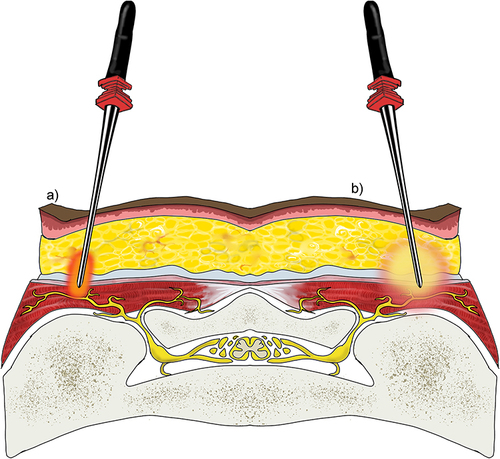 Figure 3 Conventional versus Cooled Radiofrequency Ablation. (a) Conventional RFA requires precise placement of the RFA probe within 1–2 mm of the intended target. Conventional RFA probes can reach temperatures of 100°C and insulating properties prevent heat radiofrequency waves from reaching further target tissue. (b) Cooled RFA needles utilize continuously circulating coolant within a hollow exterior shell to modulate temperature at the tip of the probe to around 60°C. This cooling mechanism avoids charring surrounding tissue, allowing for more effective heat transfer beyond the immediate proximity of the probe tip. The result is a significant difference in the overall size, shape, and area of effect of the ablated lesion, as compared to conventional RFA. Original medical illustration by Kamil Sochacki, DO.