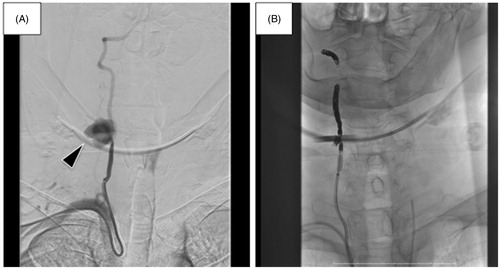 Figure 2. (A) The vertebral artery pseudoaneurysm (arrow head). (B) Successful obstruction of the right vertebral artery using coil embolization.