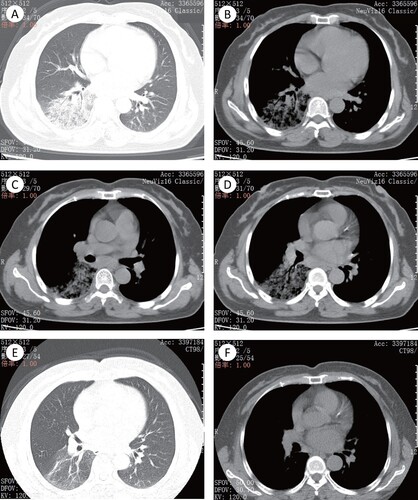 Figure 1. The imaging findings of patient 2. (A)–(D) The pulmonary window (A) and mediastinal window (B) showed the right lower lobe with segmentally distributed ground-glass opacity (GGO), with slightly uneven density and fuzzy boundary. Air bronchogram is presented in the lesion parenchyma. (C) and (D) Enlarged lymph node could be seen in mediastinal lymph nodes station 7 and 8. (E) and (F) The pulmonary window and mediastinal window showed that the pulmonary lesions were absorbed obviously, with a little light ground glass shadow left. Mediastinal lymph nodes were also significantly absorbed and shrunk.