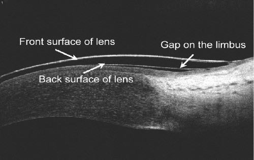 Figure 2 Visualization of limbal gaps located at the corneoscleral junction.