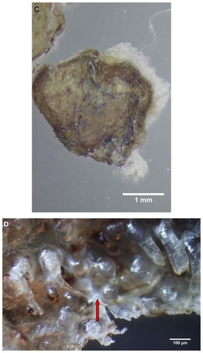 Figure 1 (A) Callus collected from patient 1. Note hyaline filaments projecting from callus. 100× magnification. (B) Callus removed from patient 2. Note blue and hyaline filaments projecting from callus surface. 40× magnification. (C) Gross microscopic view of callus removed from patient 3. Note blue filaments embedded in callus external surface. 8× magnification. (D) Callus from patient 2 demonstrating protruding keratin projections on internal surface. Note clear ingrown hair (arrow). 100× magnification.