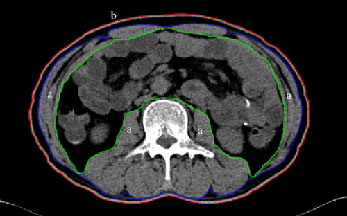 Figure 1 Example of transverse computed tomography images at 3rd lumbar vertebra. a: skeletal muscles area (between green and purple lines) b: abdominal perimeter (red line).