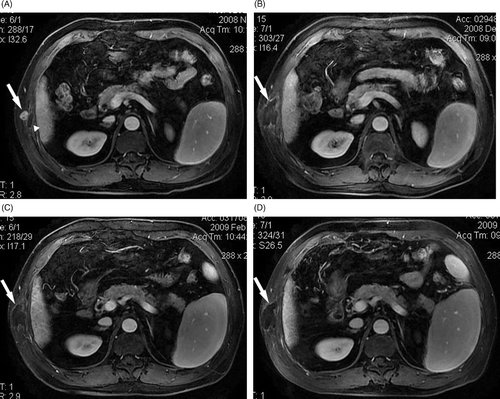 Figure 2. A 60-year-old man with needle-track seeding of HCC on the chest wall. Four months after the first HIFU ablation a recurrent lesion was detected adjacent to the treated area. (A) Before the repeat HIFU ablation a lesion (arrow) adjacent to the treated area of first HIFU ablation (arrowhead) was detected, which showed enhancement on T1-weighted contrast-enhanced MRI. No enhancement was observed in the treated area (arrow) at one month (B), three months (C), and seven months (D) after the repeat HIFU ablation.