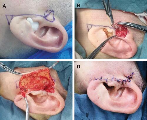 Figure 2 (A) Pre-operation label of the surgical incision; (B) resection of the preauricular lesion; (C) preparation of the Burow flap; (D) surgical site appearance after the preauricular incision is sutured.