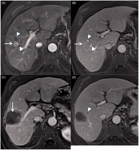 Figure 1. Contrast enhanced T1W at arterial (A) and portal (B) phase showing a hepatocellular carcinoma (white arrow) near two small hepatic veins (white arrowhead). An MRI performed one month after multibipolar radiofrequency ablation using 3 T-40 electrodes shows a large and homogeneous ablative volume (C, white arrow) with thrombosis of small hepatic vein adjacent to the tumour (D, white arrowhead).