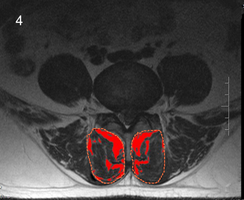 Figure 4 Fatty infiltration of LMM on MRI by ImageJ software.