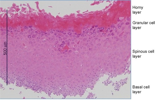 Figure 3 Histopathological finding of the white patch excised from the cornea.