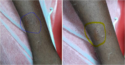 Figure 1 Shows a superficial, jagged wound on the anterior aspect of the left leg. both the blue and yellow areas indicates the healed area of honey badger bite.