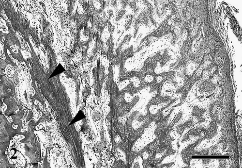 Fig. 2 Decalcified section of the tibiotarsus. Marked periosteal bone reaction with proliferation of osteoid trabeculae and loose fibrous tissue at the exterior of thinning cortex bone (arrowheads). HE. Bar=500 μm.