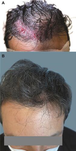 Figure 15 Case 3: (A) Frontal scalp soon after grafting; and (B) frontal area with minor signs of surgery at 48 h after long-hair implantation.