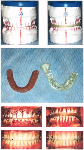 Figure 2. Top row: Prior to surgery, both splints were tested on dental casts with respect to occlusal fitting. In the first patient of the pilot series, the virtual splint (right) is still thicker than the conventional splint. Middle row: Occlusal impressions of both splints are comparable – the posterior extension of the transparent virtual splint (right) was intended to allow an assessment of the possibility of intraoperative grinding of the splint. Bottom two rows: Both splints were inserted during surgery and showed equivalent occlusal fitting with respect to the midline. Laterognathia to the right side (bottom left) was obviously improved after combined orthodontic and surgical treatment (bottom right).
