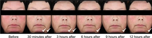 Figure 2 Standardized photos of a representative subject before and at 30 minutes, 3 hours, 6 hours, 9 hours, and 12 hours after the application of brimonidine tartrate gel on day 1.