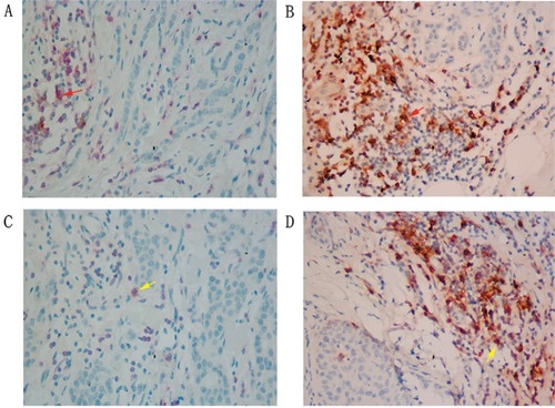 Figure 2 Coexpression of CD4/PD-1 and CD8/PD-1 on TILs in Luminal A and TNBC (×400 magnification).