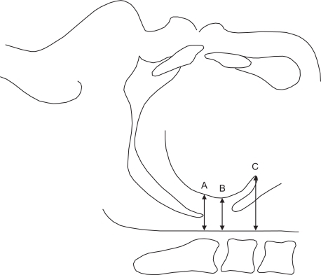 Figure 1 Measurement points in the upper airway on the lateral cephalogram. Three intervals in the sagittal diameter of upper airway at; A) Uvular tip. B) Midpoint between the 2nd and 3rd cervical vertebra as a tongue base. C) Epiglottic vallecula.