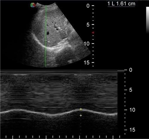 Figure 1 M-mode ultrasonography of the diaphragm of a patient with a conserved right hemidiaphragm function (DD = 16 mm).