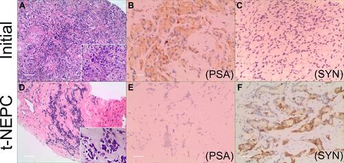 Figure 3 Pathological images of tumor. Histological and immunohistochemical staining of the initial biopsy: the normal cell architecture was disappeared and eosinophilic structures were appeared. The nucleus of tumor cells was enlarged. The Gleason Score was 9 (4 + 5) (H&E) (A). The tumor cells were positive for PSA (B) and were negative for synaptophysin (C). Scale bar 100 μm. Histological and immunohistochemical staining of the secondary biopsy after ADT: the small blue cells with less cytoplasm and a high nuclear to plasma ratio were found (H&E) (D). The tumor cells were negative for PSA staining (E) and were positive for synaptophysin (F). Scale bar 100 μm.