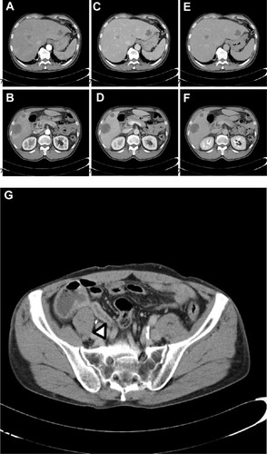 Figure 1 Abdominal CT findings on admission.