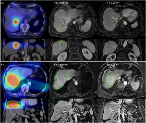Figure 1. Longitudinal course of exemplified MMAs (MR-morphologic alterations) after SBRT: Exemplified imaging of stereotactic radiotherapy of liver metastases with the longitudinal course of the MMA. Column I demonstrates the dose distribution on the basis of the treatment planning CT (Computed Tomography) scan, Column II 3 months and 1 year demonstrates the longitudinal course of the MMA being contoured with green color. Images of Column II are at the approximately same slice localization as compared to Column I. Section A) demonstrates hypointense as compared to Section B) with hyperintense MMA in transversal (first row) and coronal view (second row).