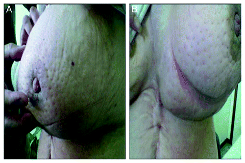 Figure 3. Left breast with swelling, redness and peau d'orange skin and nipple retraction.