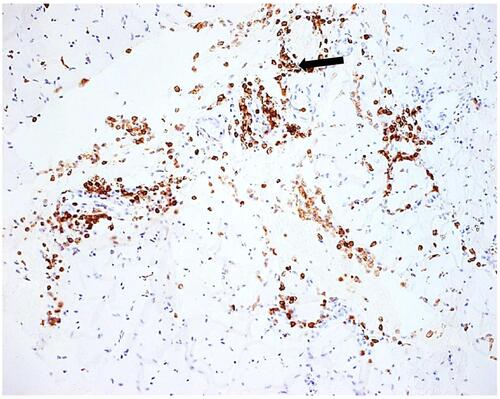 Figure 3 CD68-positive macrophages forming perivascular cuffs are present (arrow) (anti CD68×100).