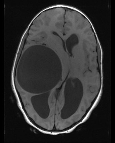 Figure 1 Axial T1-weighted brain MRI demonstrating a well-defined hypointense lesion in the right temporal lobe with significant mass effect and midline shift.
