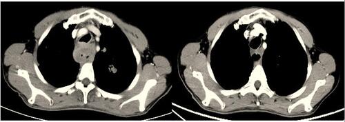 Figure 3 The CT scan results of the changes for target lesions in esophagus and lung sites of one patient with esophageal squamous cell carcinoma before and after the administration of anlotinib monotherapy.