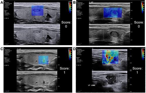 Figure 1 Representative SWE images of the hardest color. The hardest color, which corresponds to the maximum hardness inside a nodule, includes blue (A), green (B), Orange (C), and red (D).