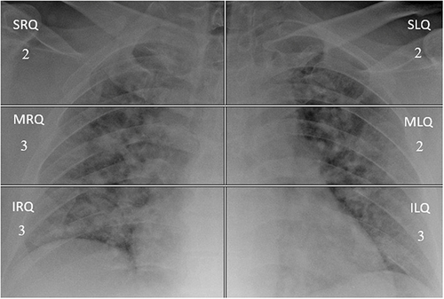 Figure 1 Example of the CXR severity score. Portable chest radiograph (CXR) of a COVID-19 patient. Division of CXR in six segments for the final evaluation score. CXR shows lower lung quadrants, middle lung quadrants, and upper lung quadrants hazy opacities; total score = 15. The patient was intubated. The numbers in each quadrant correspond to the score reported by the two radiologists. In this case there was a complete agreement, for each quadrant, between the two evaluators. The highest line passes through the middle of aortic arch. The lowest line passes through the bifurcation of inferior pulmonary arteries. 2 = presence of ground glass opacities; 3 = presence of ground glass plus consolidation with ground glass as the most widespread anomaly.