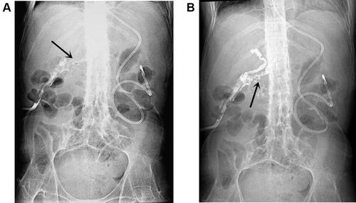 Figure 1 Abdominal plain films after injecting of a contrast agent.Notes: APD was displayed, as marked by the black arrow in (A). The main pancreatic duct and common bile duct showed up in (B).