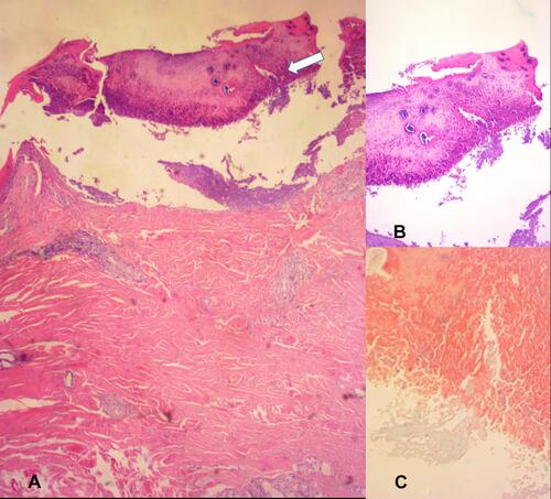 Figure 3 Histopathology of ARPC. (A) collagen fibers that vertically penetrated the epidermis (White arrow, HE×40); (B) HE×100; (C) the collagen fibers of the epidermis are stained light blue (Masson stain×400).