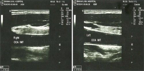 Figure 1 Color Doppler estimation of CIMT in a psoriatic patient (1.2 mm on left side and 1.6 mm on the right side).