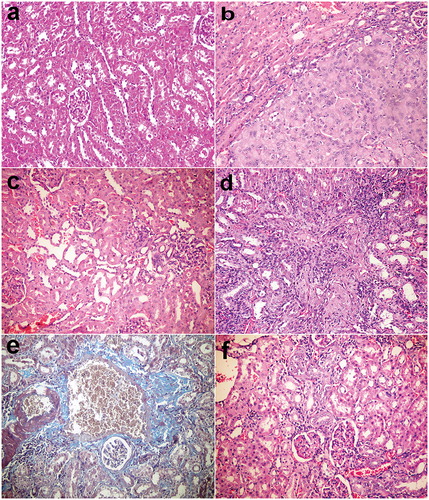 Figure 3. Kidneys, rats (38th week). (a) Normal renal tissue in group I control group. (b) Tubular cell adenoma of solid pattern with compression of adjacent parenchyma in group V injected with DENA. (c) Minor histopathological alteration in group VI injected with DENA and treated with camel milk. (d) Mononuclear inflammatory cells infiltration in the interstitial tissue with thickening of glomerular and tubular basement membrane and fibroplasia in group VII injected with DENA and treated with cisplatin. (e) Bluish-stained periglomerular and interstitial fibroplasia (Massons’ trichrome stain). (f) Few mononuclear inflammatory cells infiltration with regenerated renal tubules in group VI injected with DENA and treated with camel milk and cisplatin. Haematoxylin and eosin stain 200×.