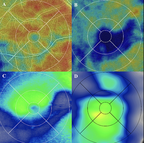 Figure 2 The 6mm × 6mm OCT-A image of a BRAO patient is divided into 9 ETDRS subfields. (A) Superficial vessel heat map. (B) Deep vessel heat map. (C) Macular thickness map. (D) Choroidal thickness map.