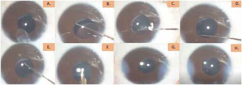 Figure 5. Procedure for ciliary sulcus fixation of IOL (A-H).