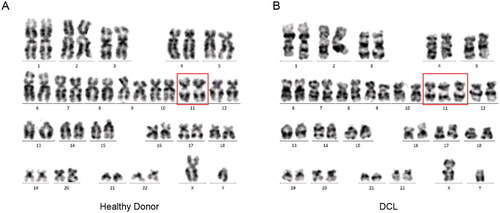 Figure 1. A karyotype performed on the DCL BM revealed 47, XY, +11. (A) Analysis of 20 metaphases, no clonal structural and number abnormalities was found in the healthy donor. (B) Analysis of 20 metaphases, an acquired genetic chromosome 11 was found in the DCL.