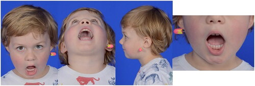 Figure 4. On physical examination at this 2-month follow up time, the patient was noted to have facial symmetry, class I occlusion, full oral excursion, and very minimal scarring at the left transfacial pin placement site.