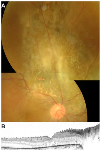 Figure 6 Color fundus photograph and spectral-domain optical coherence tomographic image after pars plana vitrectomy. The best-corrected visual acuity was 0.2. (A) Fundus photograph demonstrates retinal photocoagulation scars corresponding to retinal astrocytoma. Small residual retinal astrocytoma is seen in the center of the photocoagulation scars. (B) Horizontal optical coherence tomographic image through the fovea shows no serous retinal detachment.