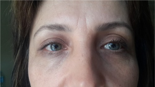 Figure 3 Ptosis and mydriasis resolved.