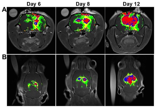 Figure 8 In vivo magnetic resonance images of rats bearing F98 gliomas in the (A) coronal view and (B) axial view. The spatial distribution of brain tumor BBB disruption with and without sonication in the right and left hemispheres, respectively, is shown. The rat brains were analyzed 30 minutes following gadolinium administration. Regions of contrast enhancement >4, >8, >12, and >16 standard deviations above the average MRI signal intensity of the normal brain tissue are shown in green, yellow, blue, and red respectively.Abbreviations: BBB, blood–brain barrier; MRI, magnetic resonance imaging.