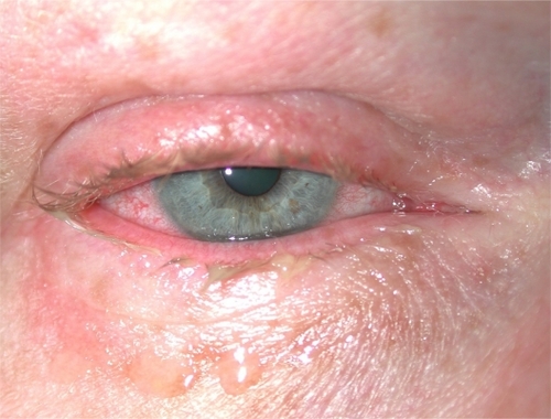 Figure 2 Chronic allergic conjunctivitis.