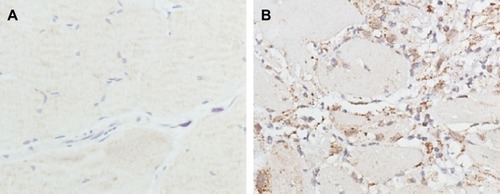 Figure 8 TGF-β1 expression in the peritoneal tissues after 7 days of treatment, detected by immunohistochemistry.Notes: High, medium and low dose groups were administered with 10, 5 and 2.5 mg/kg Tan IIA-NPs via tail vein injection, respectively. Representative images (at 200× magnification) of peritoneal tissues that were stained immunohistochemically with anti-TGF-β1 antibody. (A) Blank control group. (B) Control group. (C) Drug-free group. (D) Low-dose group. (E) Medium-dose group. (F) High-dose group. (G) Quantitative assay of OD from five randomly selected fields. The results are presented as mean ± standard deviation (n=5). *P<0.05 compared with blank; #P<0.05 compared with control; §P<0.05 compared with drug-free NPs.Abbreviations: NPs, nanoparticles; OD, optic density; TGF-β1, transforming growth factor-β1.