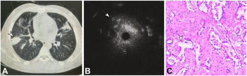 Figure 2 A 65-year-old woman had a peripheral pulmonary lesion (inflammatory pseudotumor) in the lung back segment. (A) A lesion of 30 mm×28 mm (arrow) could be seen in the back segment with an air bronchogram. (B) Endobronchial ultrasound could detect a heterogeneous lesion with diffuse short signals. (C) A few distorted and expanded bronchia existed in the inflammatory cells and normal cells (HE ×100).