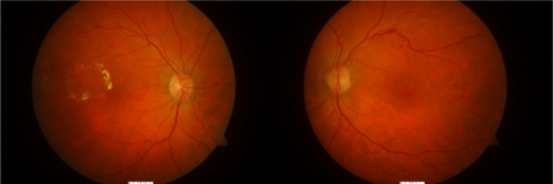 Figure 1 Color fundal photos demonstrating signs of branch vein occlusions in both left and right eyes.