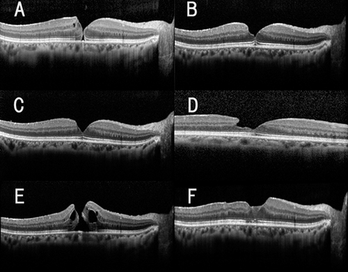Figure 1 Serial optical coherence tomographic (OCT) images showing the development of a full thickness macular hole (FTMH) in a vitrectomized eye. Optical coherence tomographic (OCT) image of the retina with an epiretinal membrane that developed 8 months after a vitreous surgery (A). Two weeks later, the MH spontaneously closed. The OCT image was obtained 4 months later (B). A lamellar macular hole (LMH) with epiretinal proliferations developed 11 months later (C and D). Note that the image in D was obtained from raster images (6 mm in length) and it shows the epiretinal proliferation. A recurrence of the MH was found 13 months after the spontaneous closure of the MH (E), which was closed by a second vitrectomy (F). The OCT images were obtained on the following dates. (A). 201X. 1. 30, (B). 201X. 5. 28, (C and D). 201X+1. 1. 22, (E). 201X+1. 3. 18, (F). 201X+1. 6. 20.