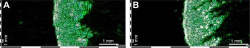 Figure 1 Ultrasonographic aspect of healthy skin (A) and skin with stretchmarks (B). 22 MHz transducer, B-scan; images from the same individual (Dub®cutis, Lüneburg, Germany). Striae distensae are delineated as low-echogenic bands inside the dermis surrounded by high-echogenic areas.