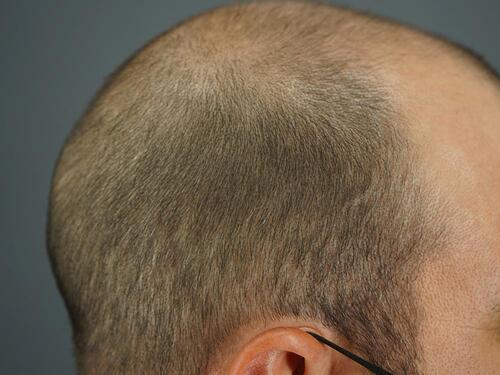 Figure 9 Examples of medium thickness/firmness and straight hair type. The right scalp of patient 7 (Caucasian man) with medium scalp thickness/firmness before his head shaving showing straight hair.