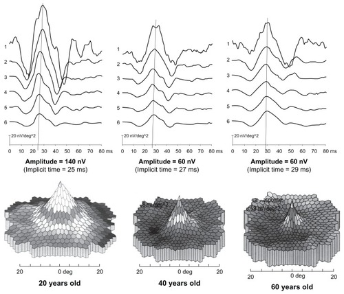 Figure 2 Age-related changes seen in mfERG testing. The upper part shows the quantitative ring analysis while the lower part shows the three-dimensional analysis. Approximately 50% of the response is lost between 20 and 40 years of age. The response stabilizes between 40 and 60 years of age and little further loss occurs. The implicit time increases from 25 to 29 milliseconds over the 40 years.